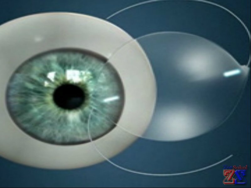 Линзы могут быть гибкими и жесткими Линзы могут быть гибкими и жесткими