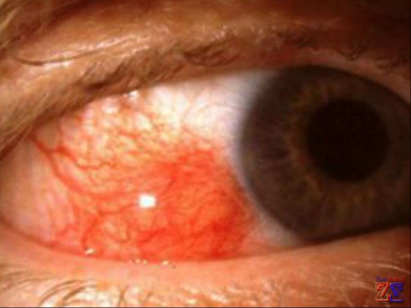Глаз, пораженный эписклеритом Глаз, пораженный эписклеритом