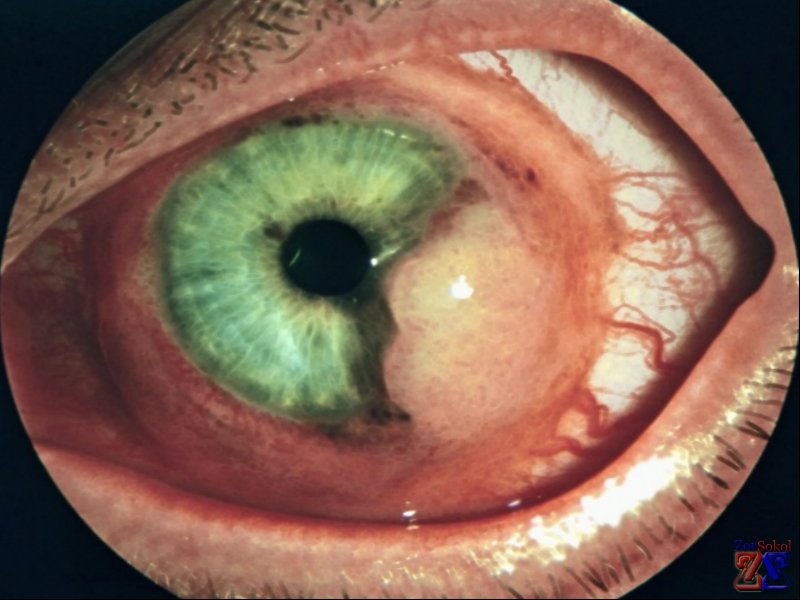 Вид роговичной эрозии Вид роговичной эрозии