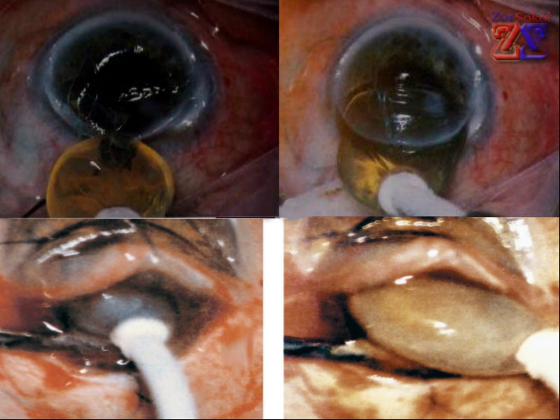 Вот так раньше удаляли хрусталик Вот так раньше удаляли хрусталик