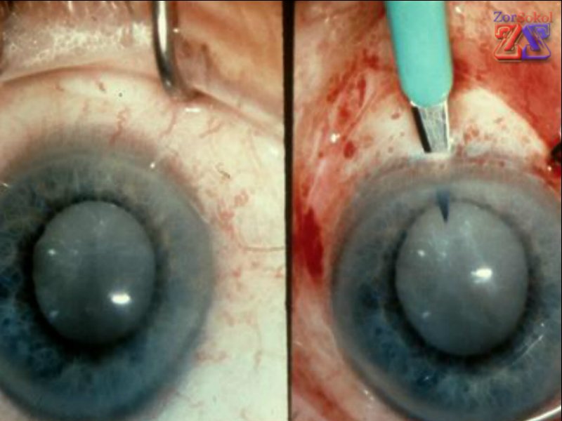 Можно удалить любую катаракту Можно удалить любую катаракту