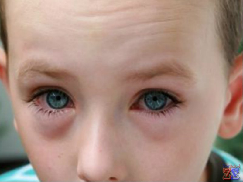 Показания - инфекционные воспаления глаз Показания - инфекционные воспаления глаз