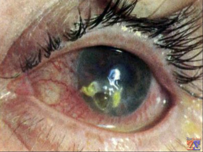 Герпес на роговице Герпес на роговице