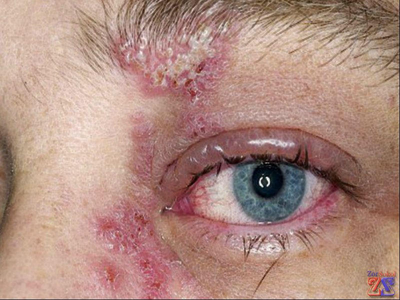 Сыпь может распространяться и вокруг глаз Сыпь может распространяться и вокруг глаз