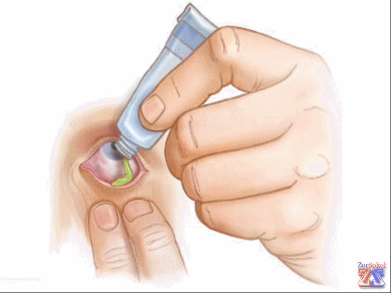 Выдавливается тоненькая полосочка мази для закладывания за веко Выдавливается тоненькая полосочка мази для закладывания за веко