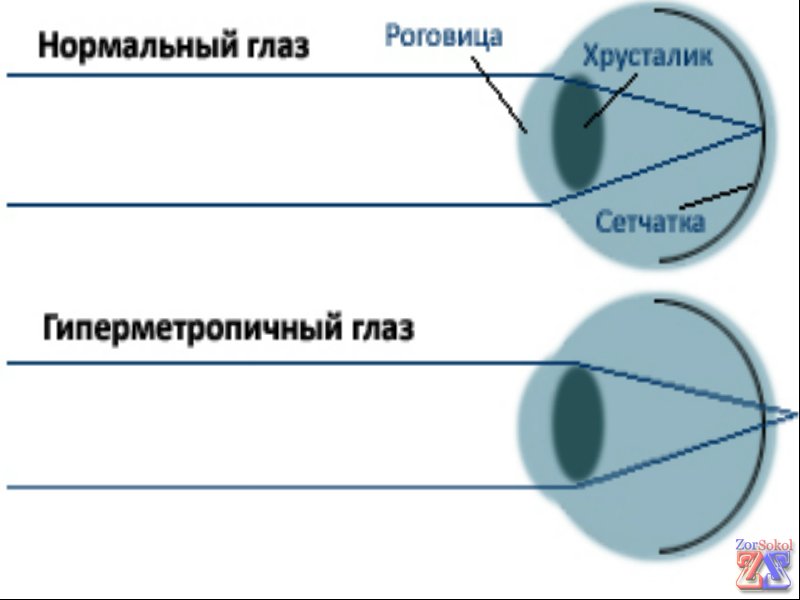 При дальнозоркости изображение проецируется за сетчаткой При дальнозоркости изображение проецируется за сетчаткой