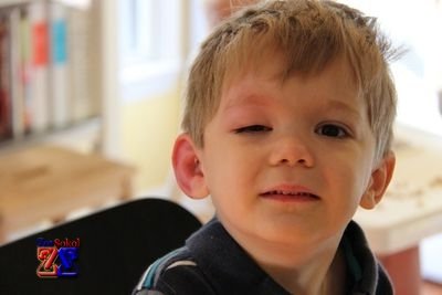 Случаи опухания глаз: укус насекомого Случаи опухания глаз: укус насекомого