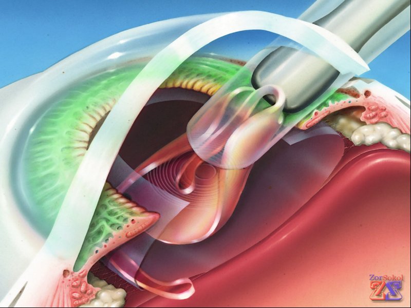 Имплантация ИОЛ Имплантация ИОЛ