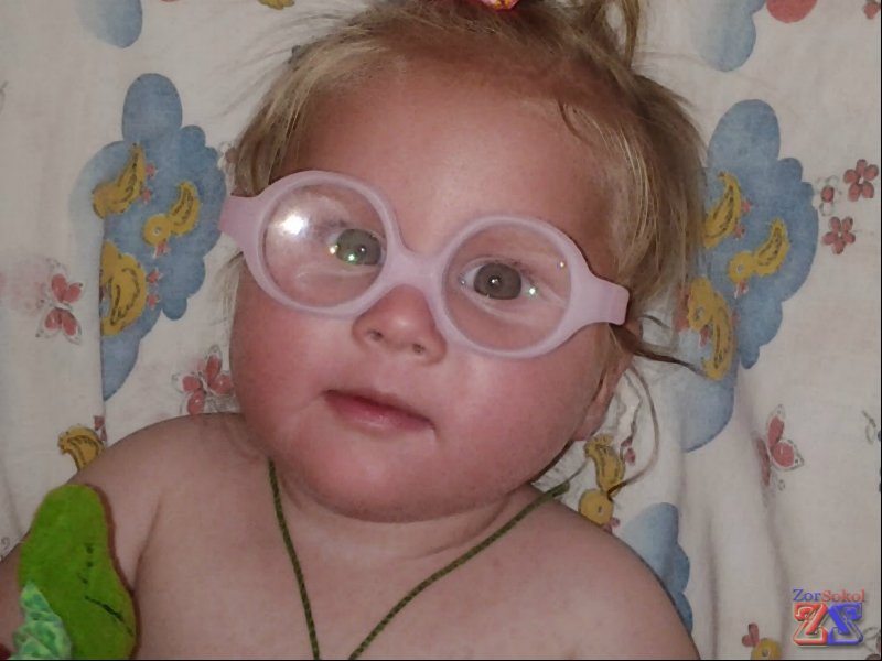 После удаления катаракты на обоих глазах После удаления катаракты на обоих глазах