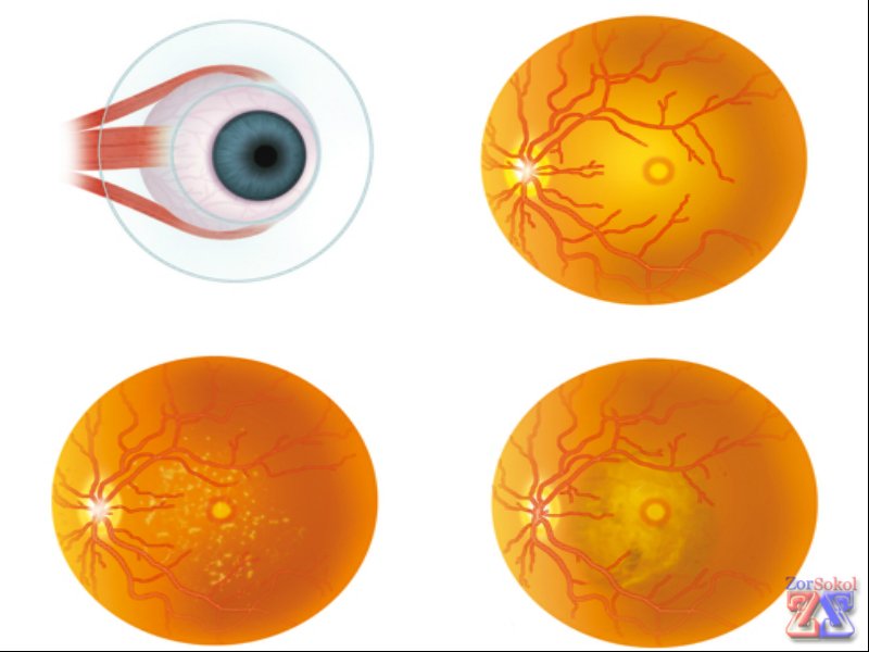 Нормальное и анормальное состояние глазного дна Нормальное и анормальное состояние глазного дна