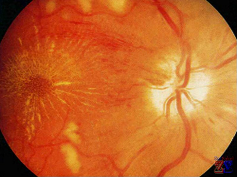 Вид глазного дна при гипертензии Вид глазного дна при гипертензии