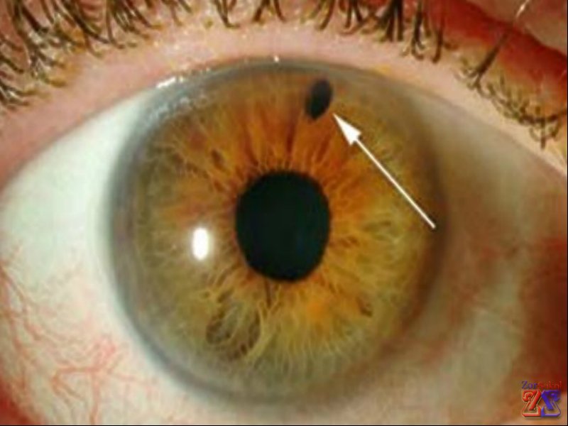 Пигментная глаукома Пигментная глаукома