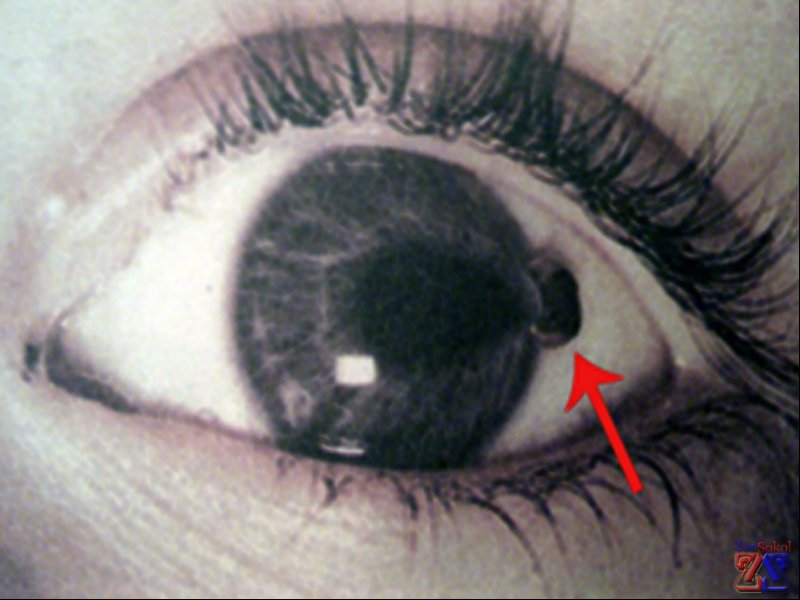 Травмы глаз очень опасны Травмы глаз очень опасны