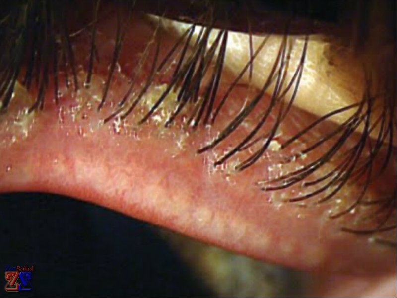 Демодекоз век Демодекоз век