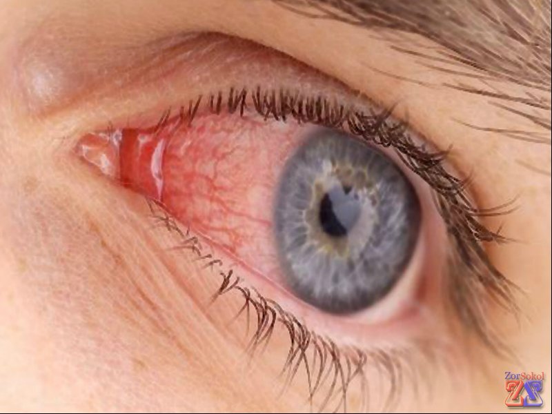 Аллергия глаз Аллергия глаз