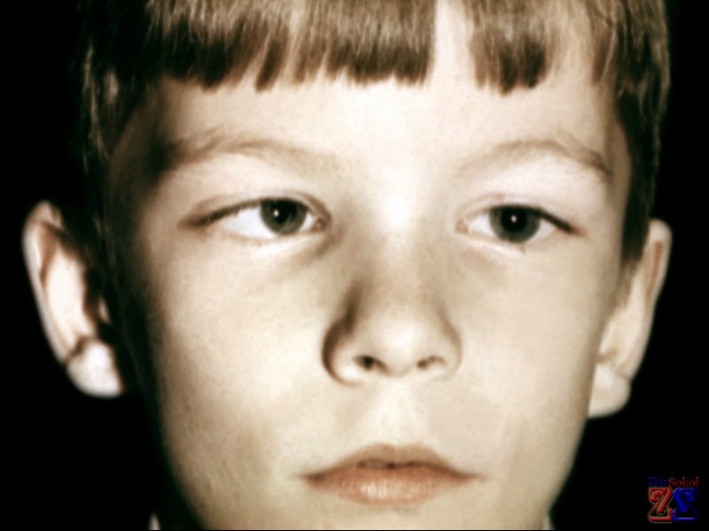 Детское косоглазие Детское косоглазие