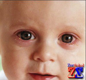 Лечение каплями для глаз Лечение каплями для глаз