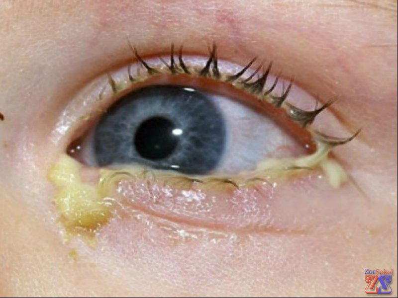 При инфекционном воспалении выбор капель зависит от его возбудителя При инфекционном воспалении выбор капель зависит от его возбудителя