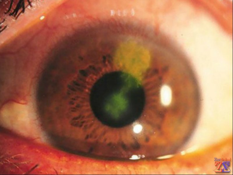 Вид грибкового кератита Вид грибкового кератита