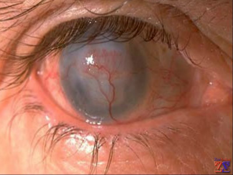 После заболевания может остаться бельмо После заболевания может остаться бельмо