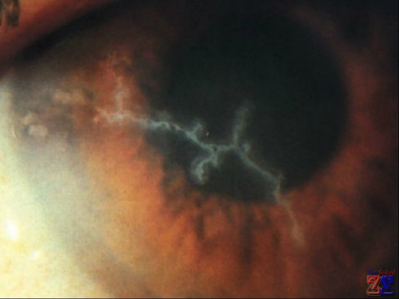 Вид древовидного герпетического кератита Вид древовидного герпетического кератита