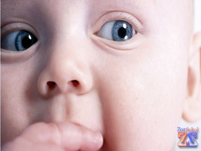 Анизокория у младенца Анизокория у младенца