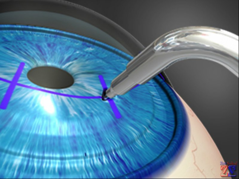 Лазер - отличная альтернатива скальпелю Лазер - отличная альтернатива скальпелю