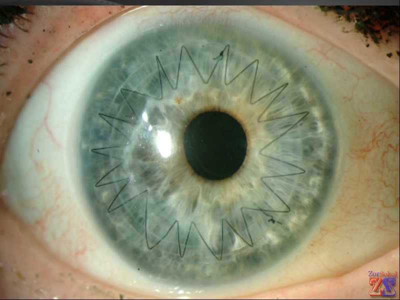 Швы снимают примерно через год Швы снимают примерно через год