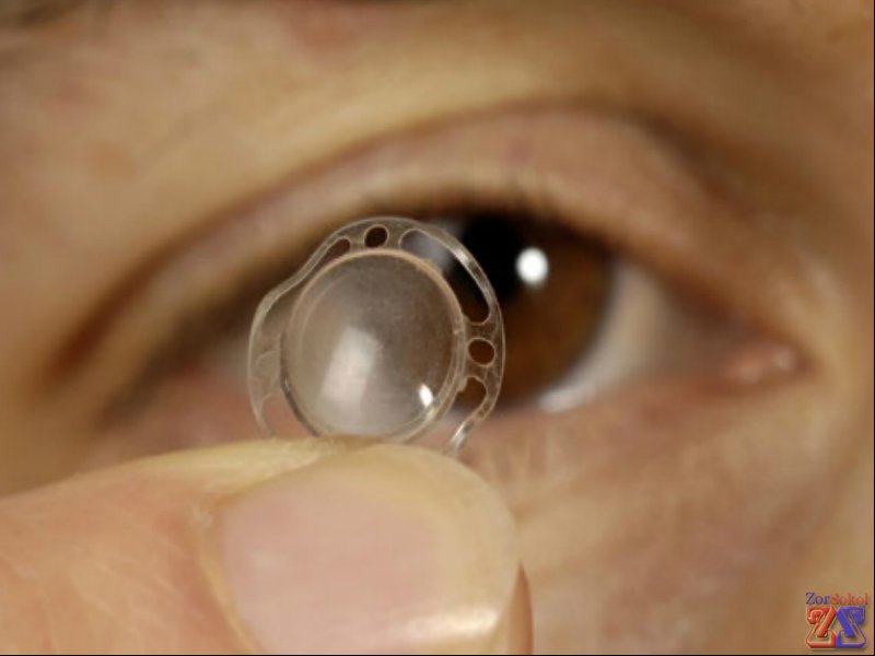 Донорская или искусственная роговица? Донорская или искусственная роговица?