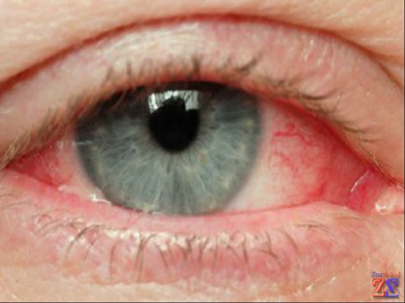 Если есть дискомфорт, нужно проконсультироваться с офтальмологом Если есть дискомфорт, нужно проконсультироваться с офтальмологом