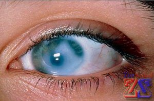 Глаз, пораженный ВГД Глаз, пораженный ВГД