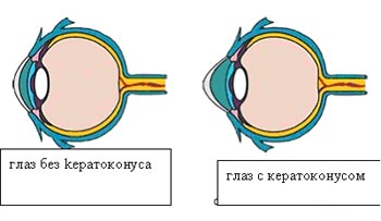 Кератоконус