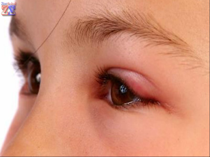 Начало воспаления Начало воспаления