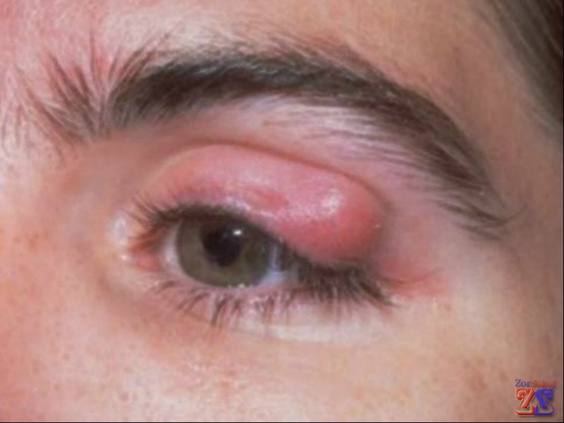 Более поздняя стадия халязиона Более поздняя стадия халязиона