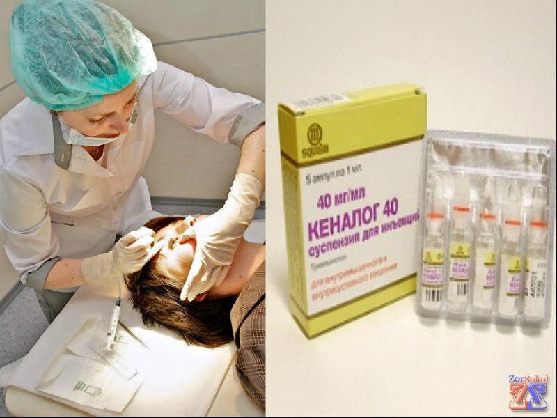 Инъекция Кеналога Инъекция Кеналога