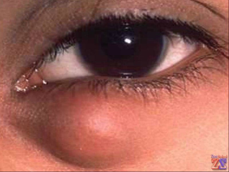 "Внешность" халязиона "Внешность" халязиона