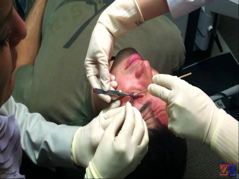 Удаление халязиона Удаление халязиона