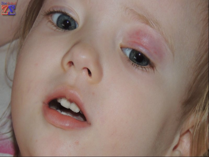 Может появляться у детей и взрослых Может появляться у детей и взрослых