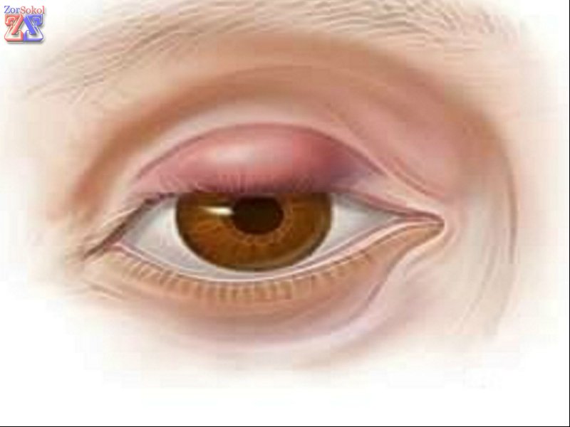 Операция назначается в запущенных случаях Операция назначается в запущенных случаях