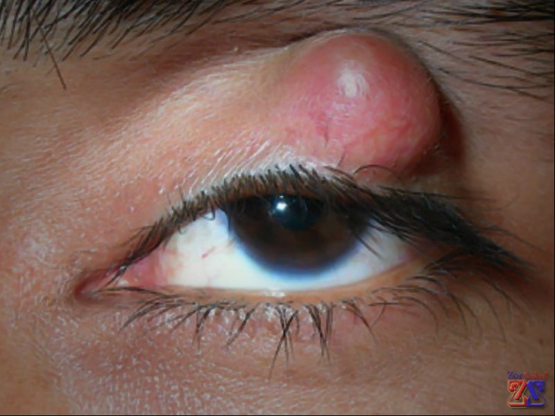 Горошина, украшающая верхнее веко Горошина, украшающая верхнее веко