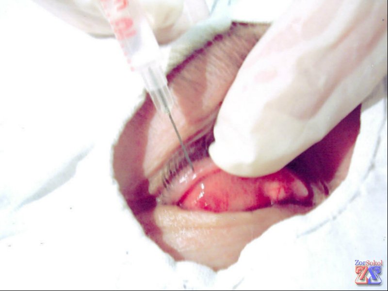 Инъекция в полость халязиона Инъекция в полость халязиона