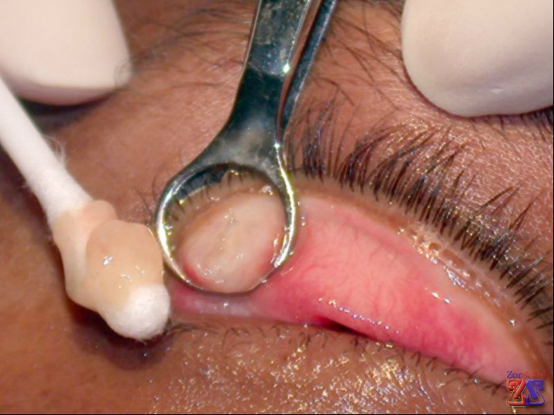 Так происходит удаление халязиона Так происходит удаление халязиона