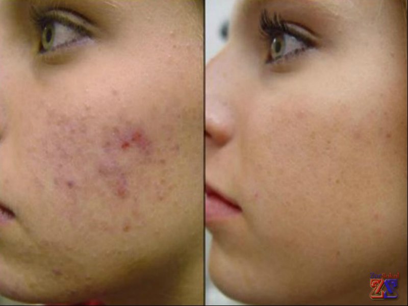 До и после применения мыла и крема До и после применения мыла и крема