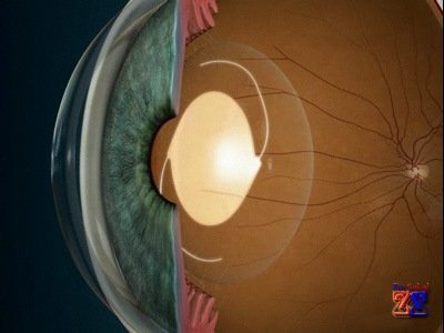 Закрепление хрусталика Закрепление хрусталика
