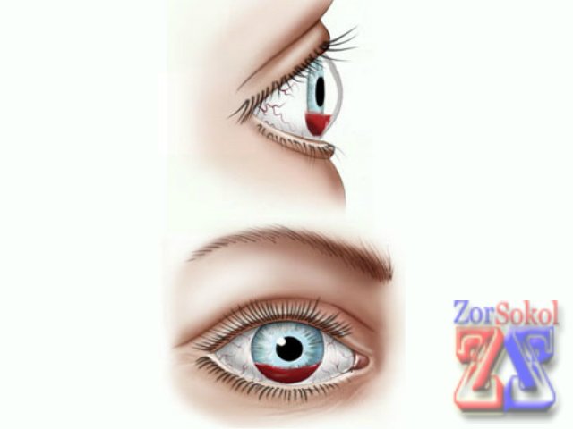 Гифема Гифема