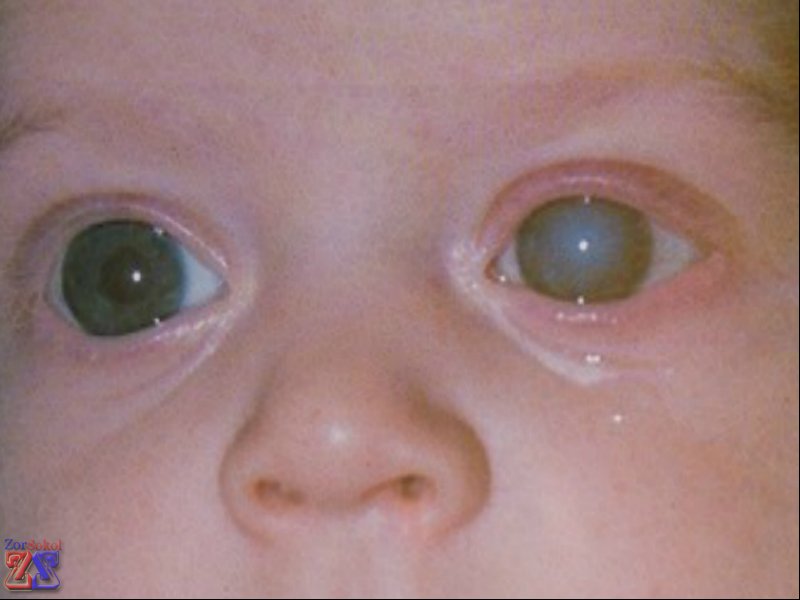 Глаукома может быть и у детей Глаукома может быть и у детей