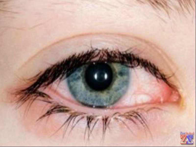 Один из симптомов конъюнктивита - покраснение глаз Один из симптомов конъюнктивита - покраснение глаз