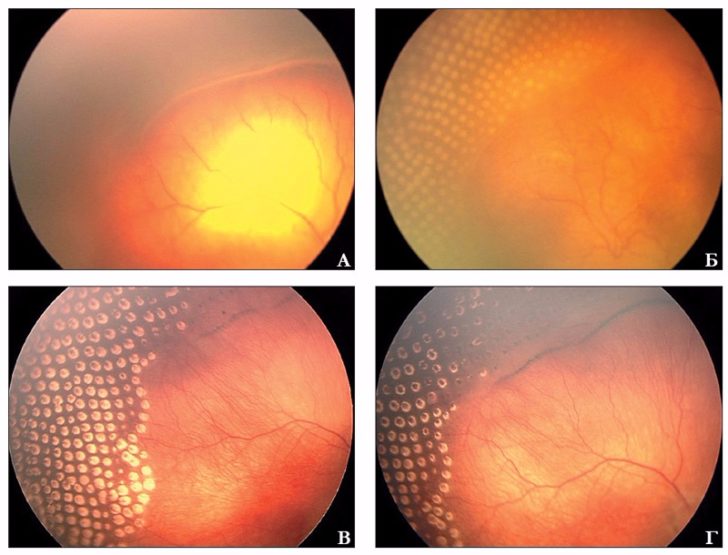 Лечение ретинопатии