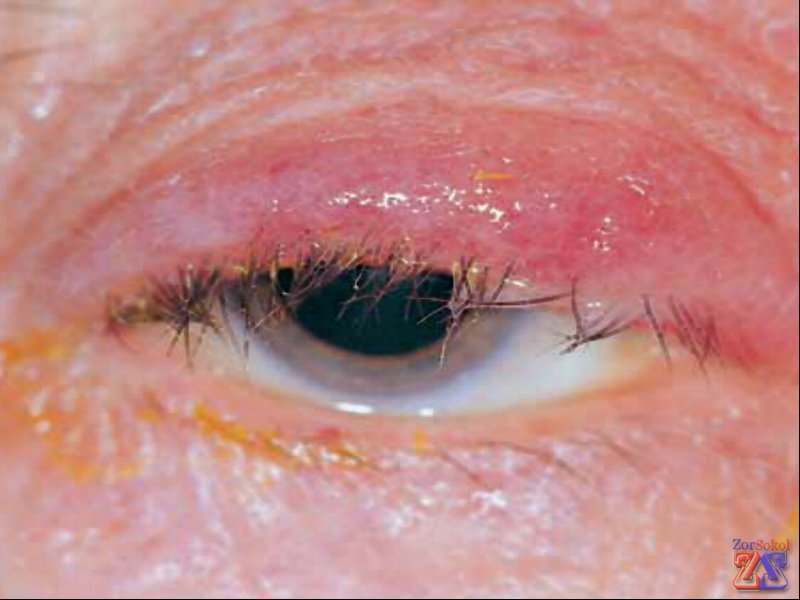 Так выглядят больные глаза Так выглядят больные глаза