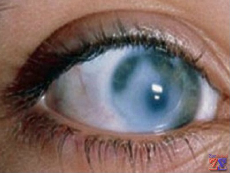 Лейкома - помутнение роговицы Лейкома - помутнение роговицы